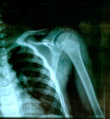 Let your physician set the bones, then come see us.  Acupuncture can decrease your pain and improve your function so you make the most out of your physical therapy for a more complete recovery.